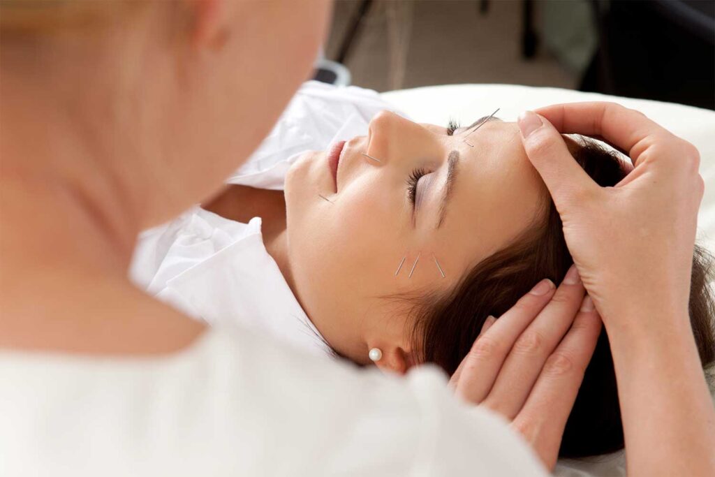 Acupuncture needles inserted in woman's head for treatment.