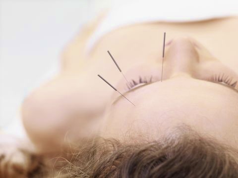 Acupuncture needles inserted in woman's head for treatment.