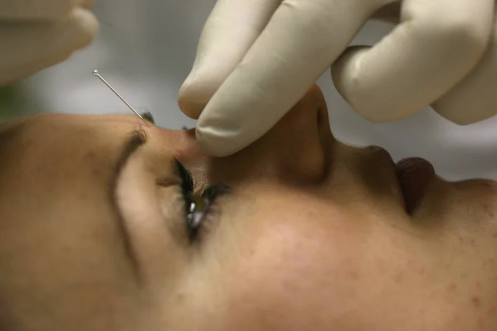 A woman undergoing acupuncture treatment with needles on her face.