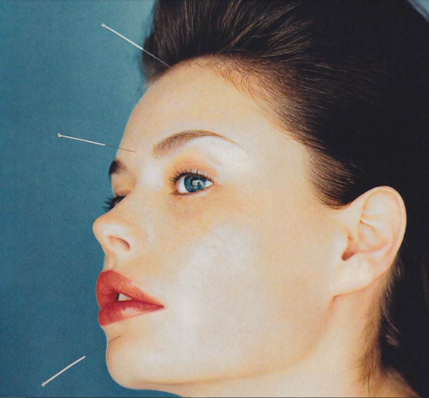 A woman undergoing acupuncture treatment with needles on her face.