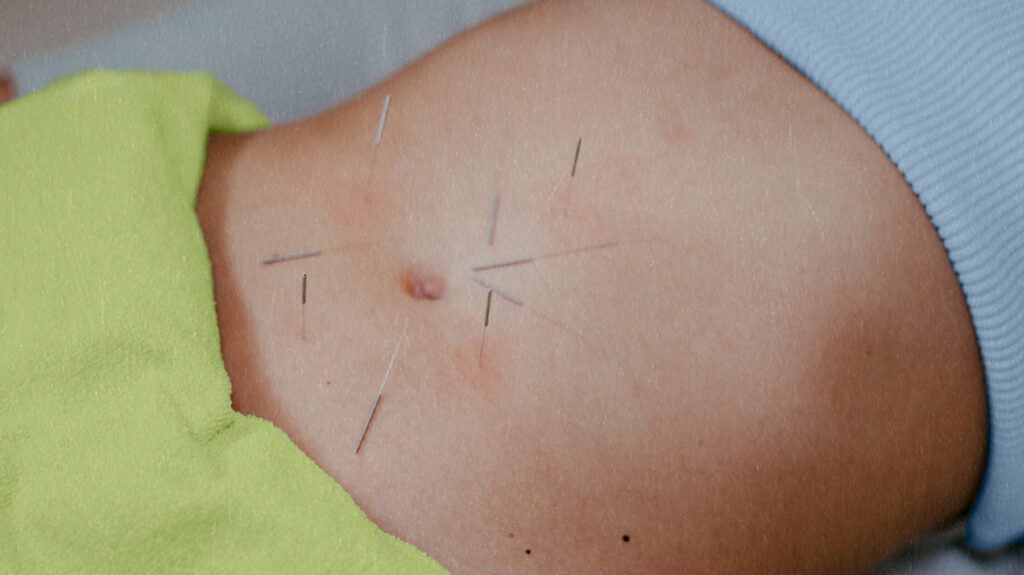 Acupuncture treatment for back pain, showing a person receiving acupuncture therapy on their back.