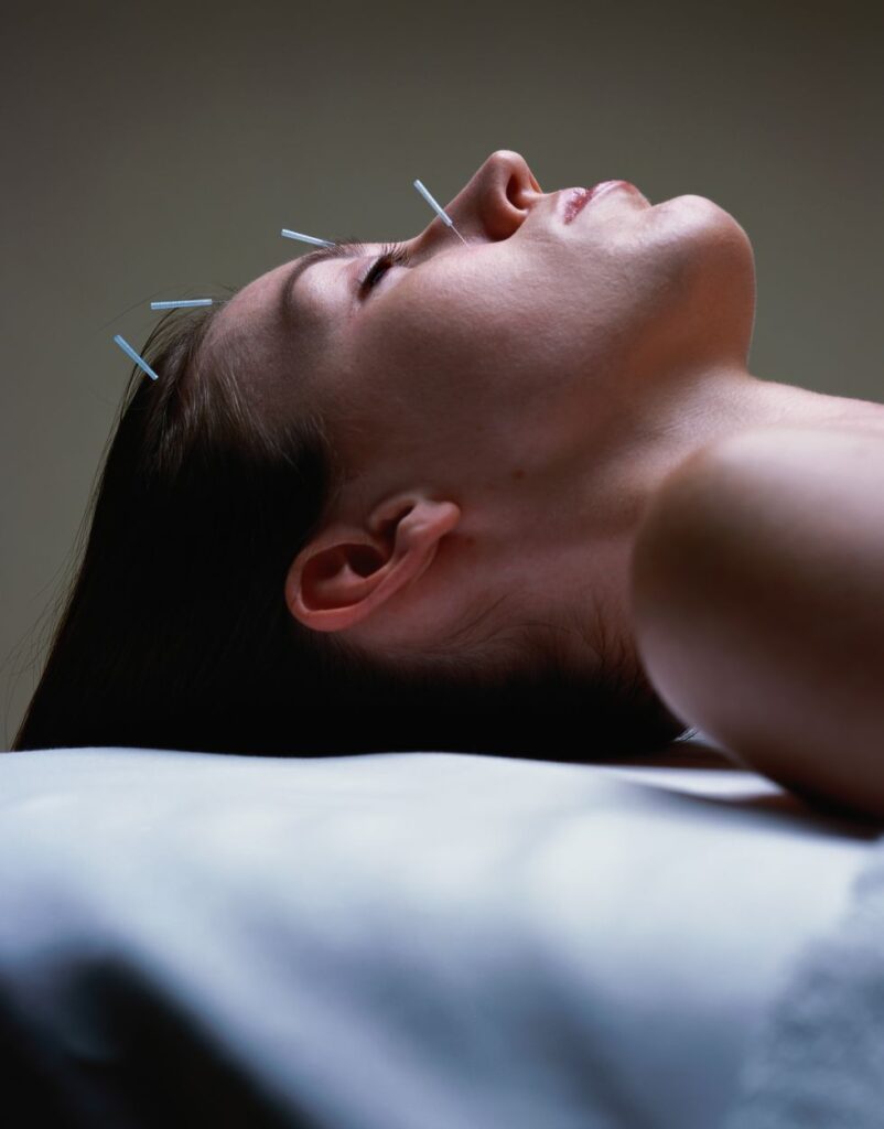 Acupuncture treatment for back pain, showing a person receiving acupuncture therapy on their back.