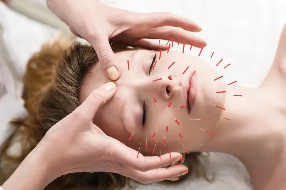 Acupuncture treatment for headaches: A person lying down with thin needles inserted into specific points on their head and neck.